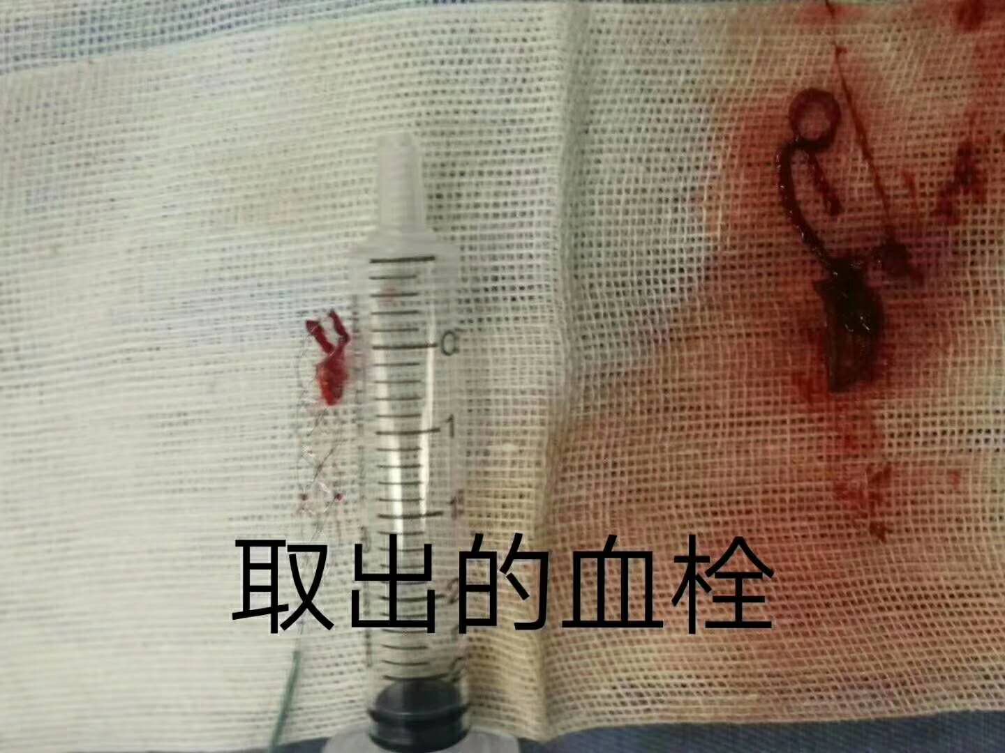 Ժֳɹʩ˨ȡ˨g(sh)Ȳ